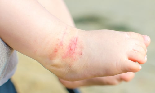 Expert Advice On How To Manage Your Child's Eczema symptoms